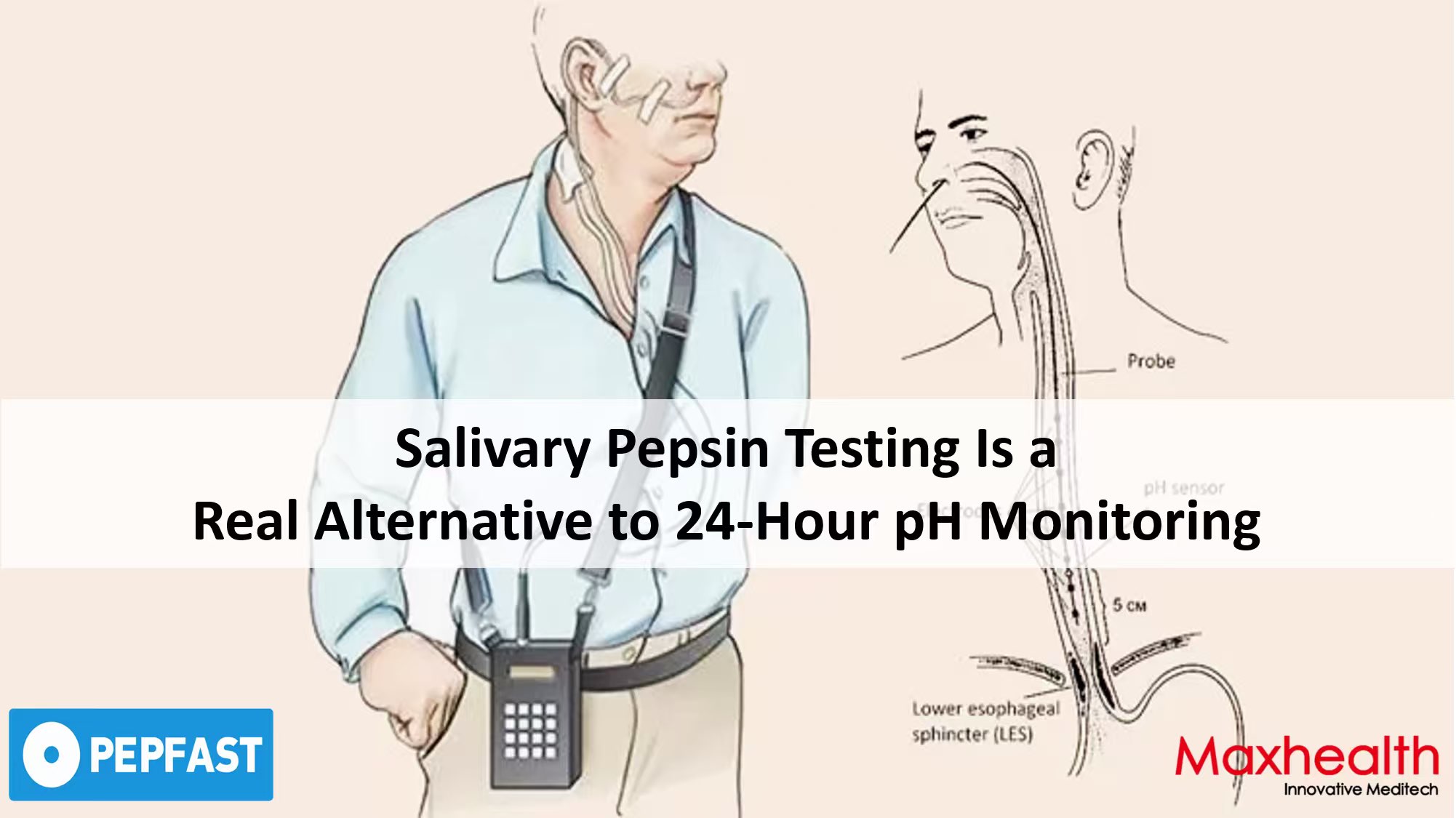 Por qué la prueba de pepsina salival es una alternativa real al monitoreo de pH de 24 horas.